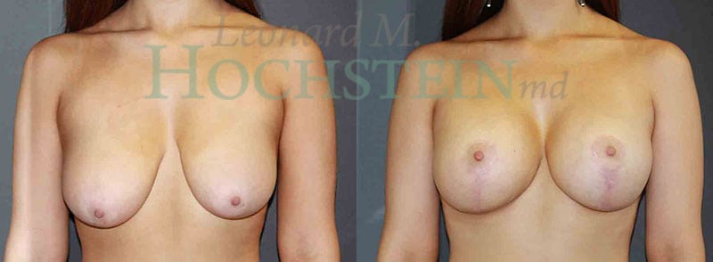 Breast Lift With Implants Patient