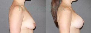 Breast Lift With Implants Patient
