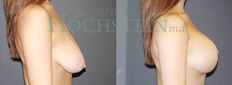 Breast Lift With Implants Patient