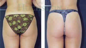 Liposuction Patient 02