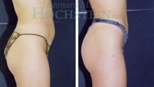 Liposuction Patient 02a
