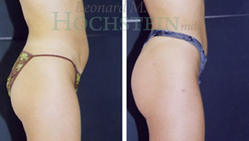 Liposuction Patient