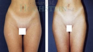 Liposuction Patient 03