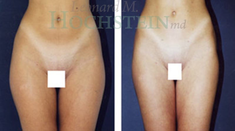 Liposuction Patient