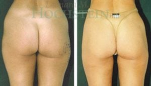 Liposuction Patient 04