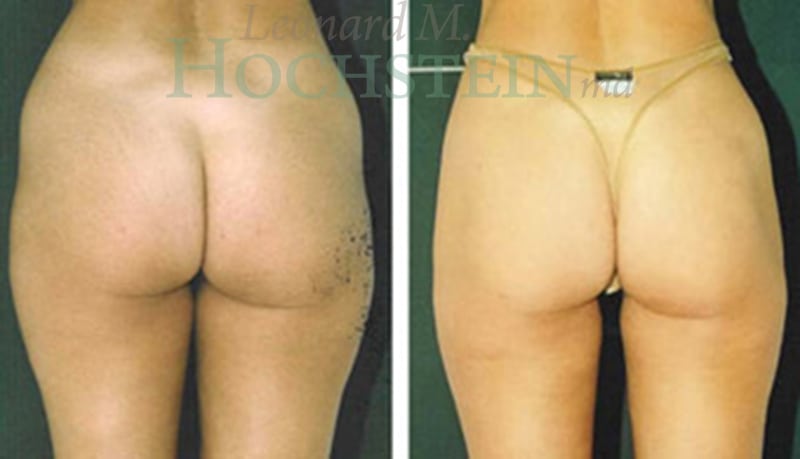 Liposuction Patient