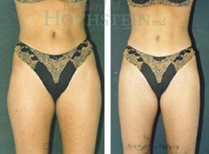 Liposuction Patient 05