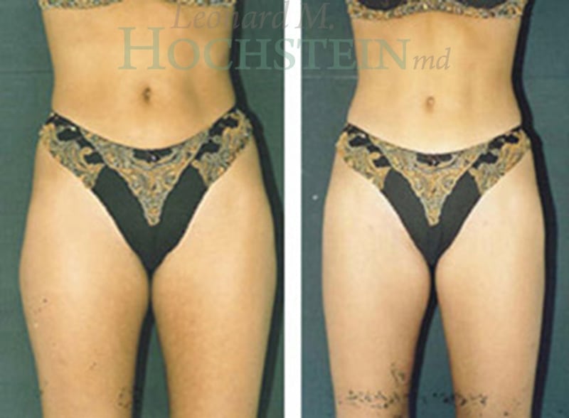 Liposuction Patient