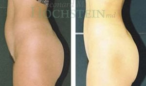 Liposuction Patient 05a