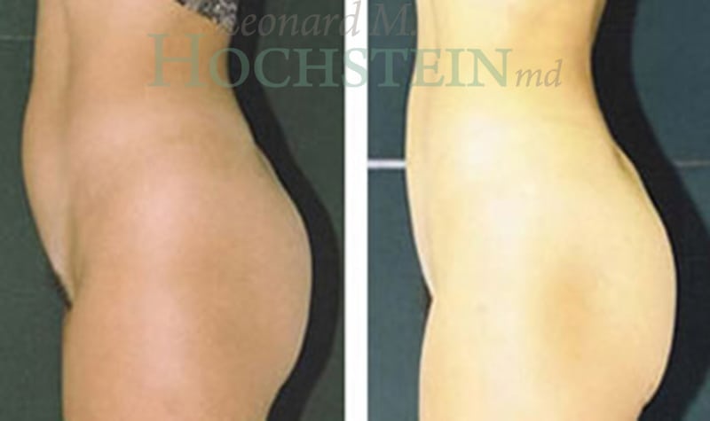 Liposuction Patient
