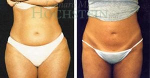 Liposuction Patient 06