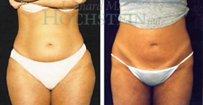Liposuction Patient