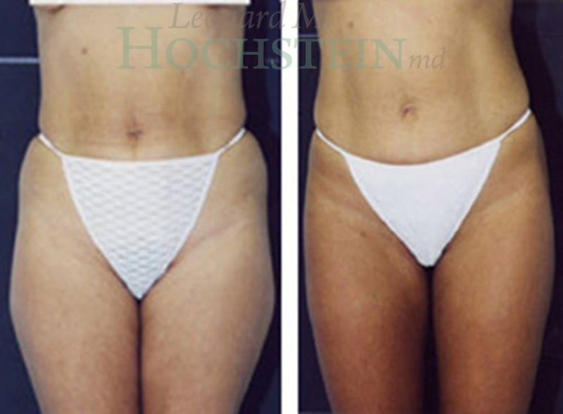Liposuction Patient