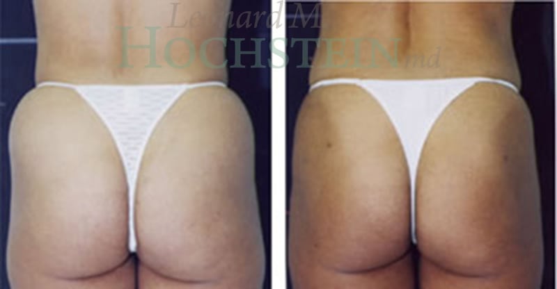 Liposuction Patient