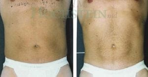 Liposuction Patient 08
