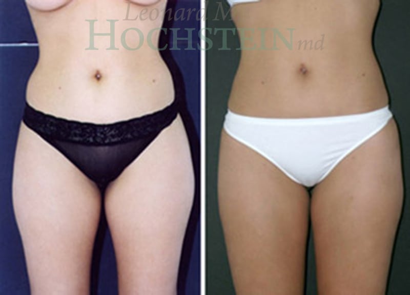 Liposuction Patient