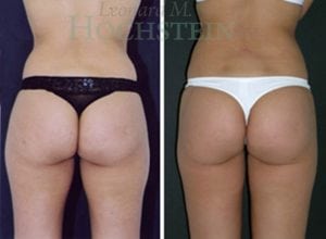 Liposuction Patient 09a