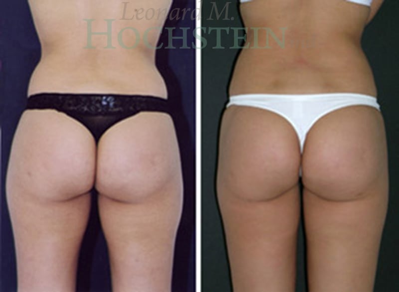 Liposuction Patient