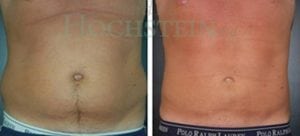 Liposuction Patient 10