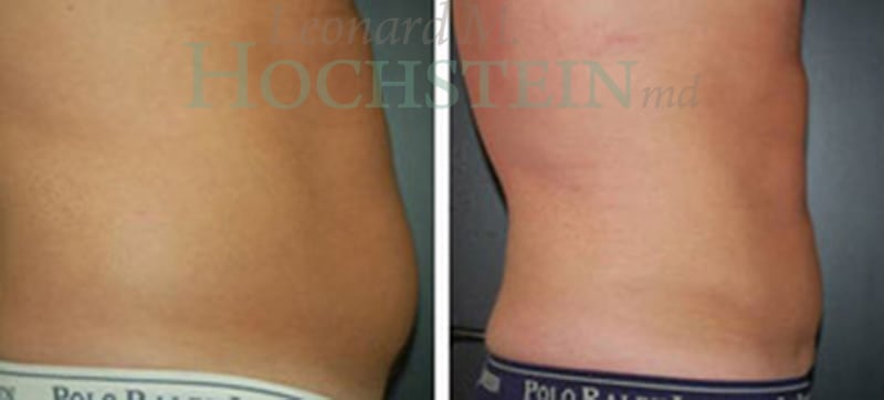 Liposuction Patient