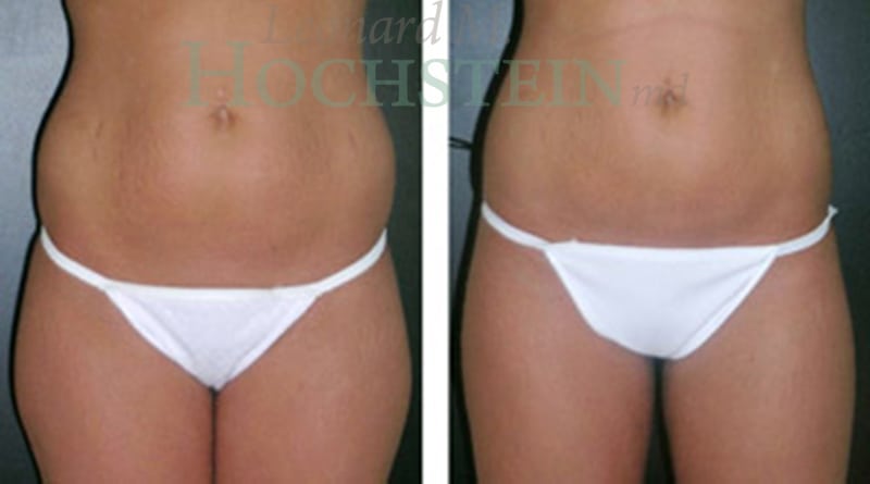 Liposuction Patient
