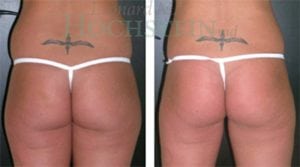 Liposuction Patient 11a