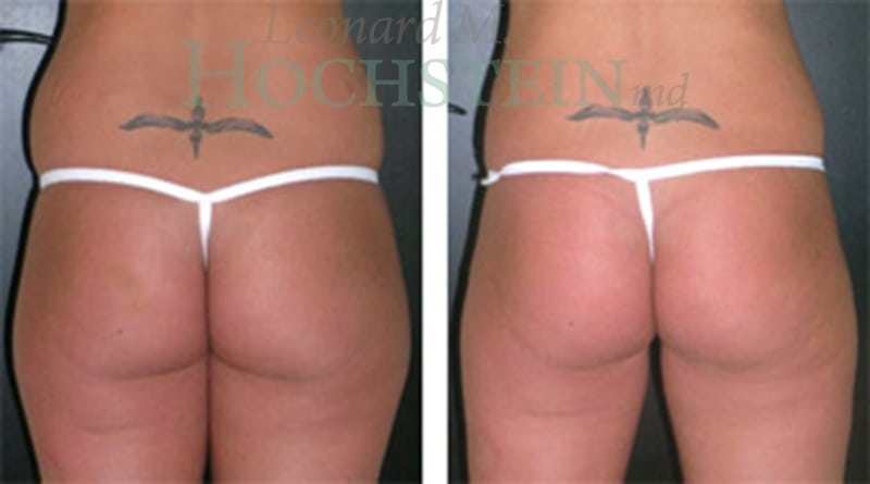 Liposuction Patient