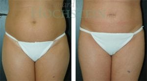 Liposuction Patient 12