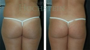 Liposuction Patient 12a