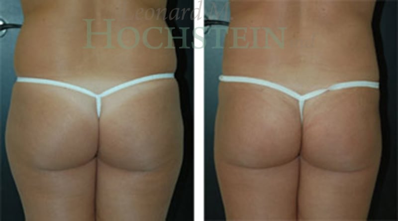 Liposuction Patient