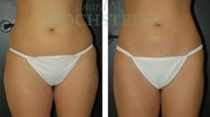 Liposuction Patient 13