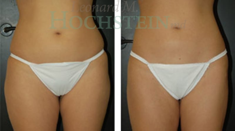 Liposuction Patient