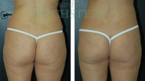 Liposuction Patient 13a