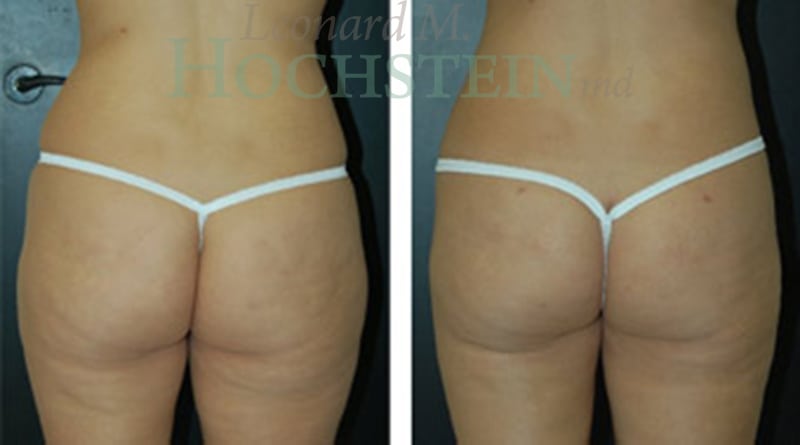 Liposuction Patient