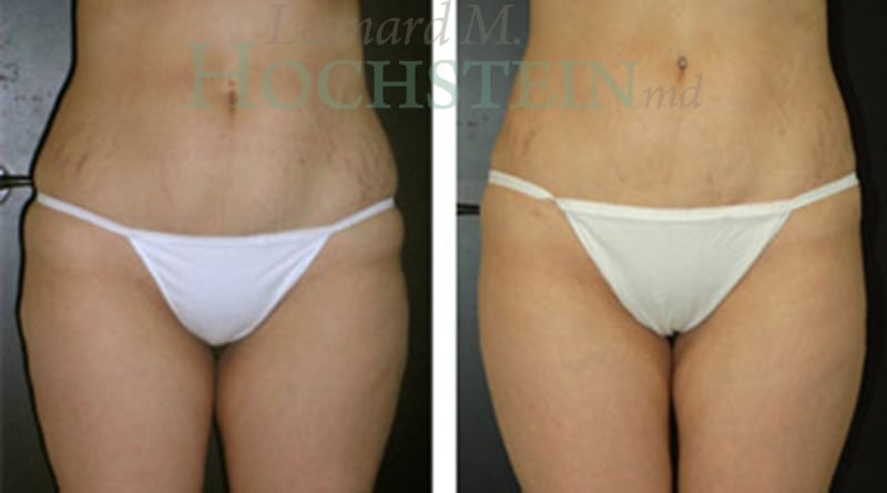 Liposuction Patient