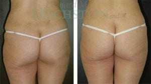 Liposuction Patient 14a