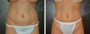 Liposuction Patient 15