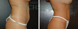 Liposuction Patient 15a