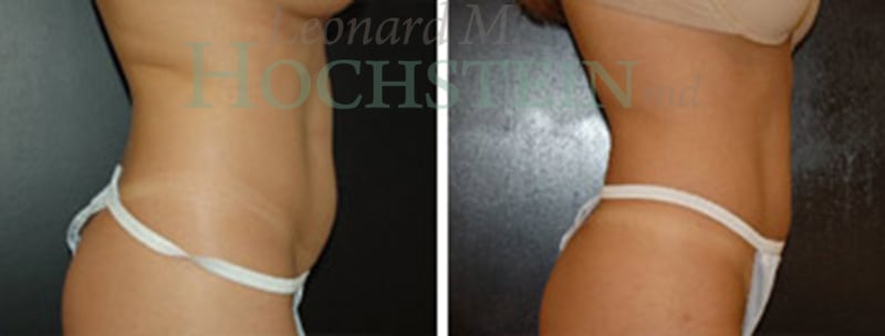 Liposuction Patient