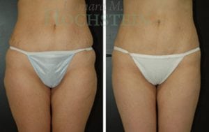 Liposuction Patient 16