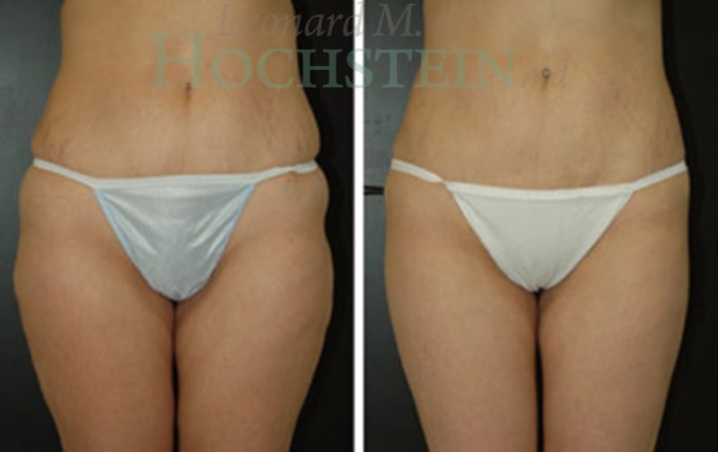 Liposuction Patient