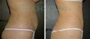 Liposuction Patient 16a