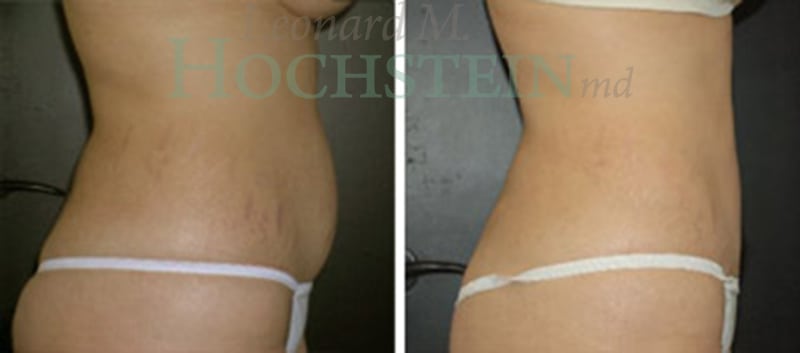 Liposuction Patient