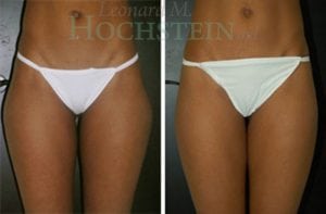 Liposuction Patient 17