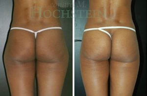 Liposuction Patient 17a
