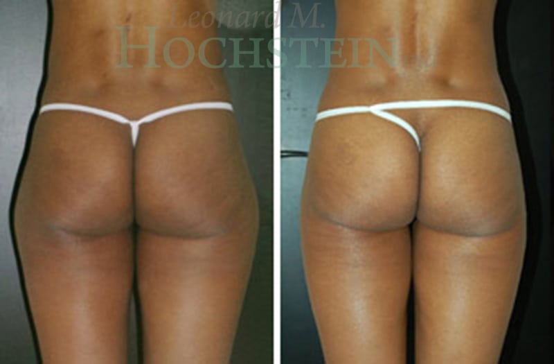Liposuction Patient