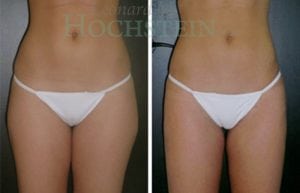 Liposuction Patient 18