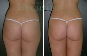 Liposuction Patient 18a