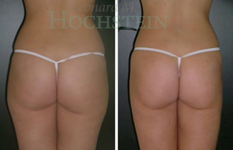 Liposuction Patient