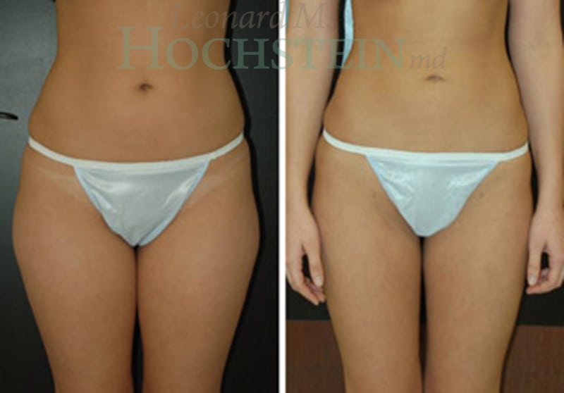 Liposuction Patient